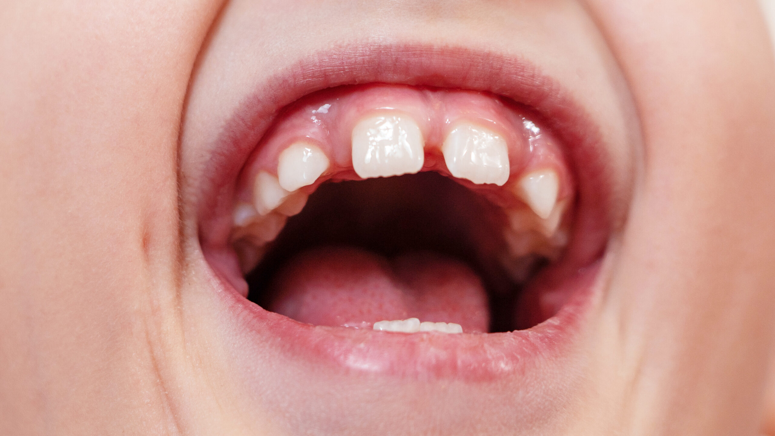 子どもがすきっ歯になる原因